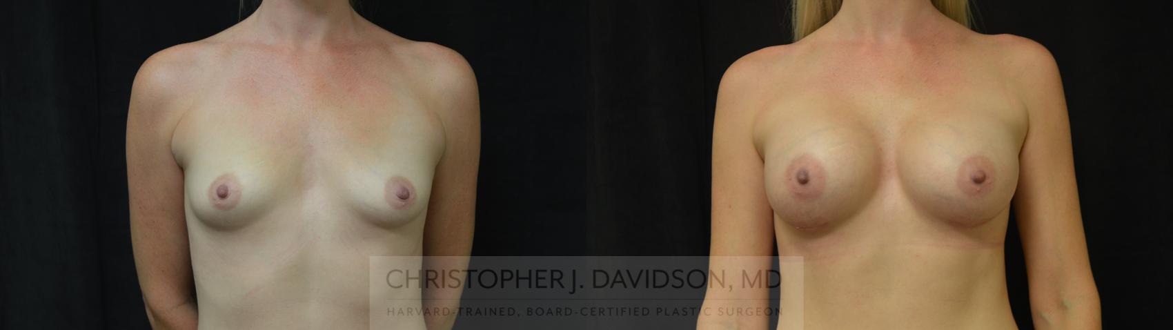 Breast Augmentation Case 446 Before & After Front | Boston, MA | Christopher J. Davidson, MD