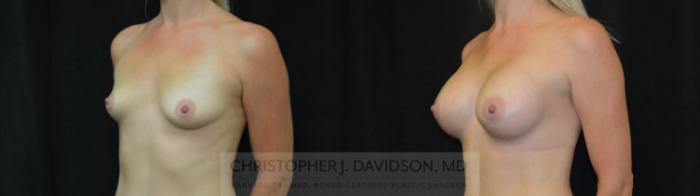 Breast Augmentation Case 446 Before & After Left Oblique | Boston, MA | Christopher J. Davidson, MD