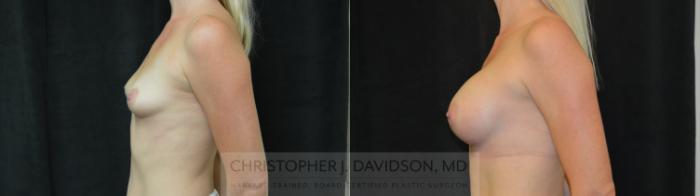 Breast Augmentation Case 446 Before & After Left Side | Boston, MA | Christopher J. Davidson, MD