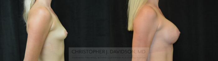Breast Augmentation Case 446 Before & After Right Side | Boston, MA | Christopher J. Davidson, MD