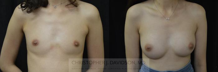 Breast Augmentation Case 449 Before & After Front | Boston, MA | Christopher J. Davidson, MD