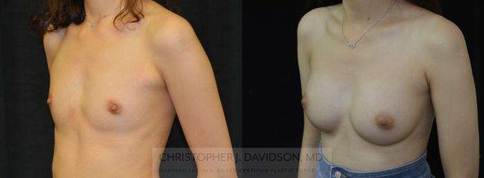 Breast Augmentation Case 449 Before & After Left Oblique | Boston, MA | Christopher J. Davidson, MD
