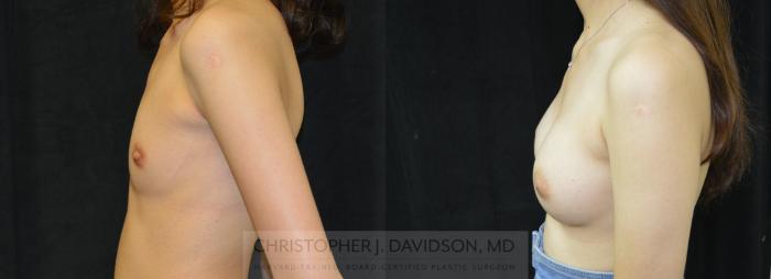 Breast Augmentation Case 449 Before & After Left Side | Boston, MA | Christopher J. Davidson, MD