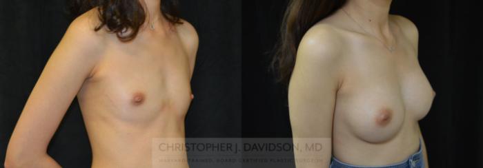 Breast Augmentation Case 449 Before & After Right Oblique | Boston, MA | Christopher J. Davidson, MD