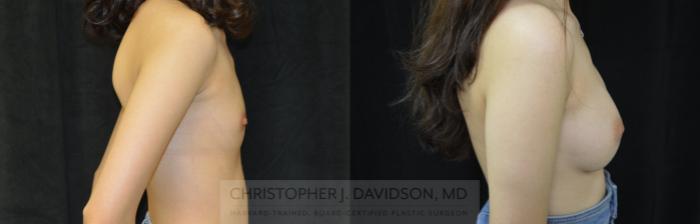 Breast Augmentation Case 449 Before & After Right Side | Boston, MA | Christopher J. Davidson, MD