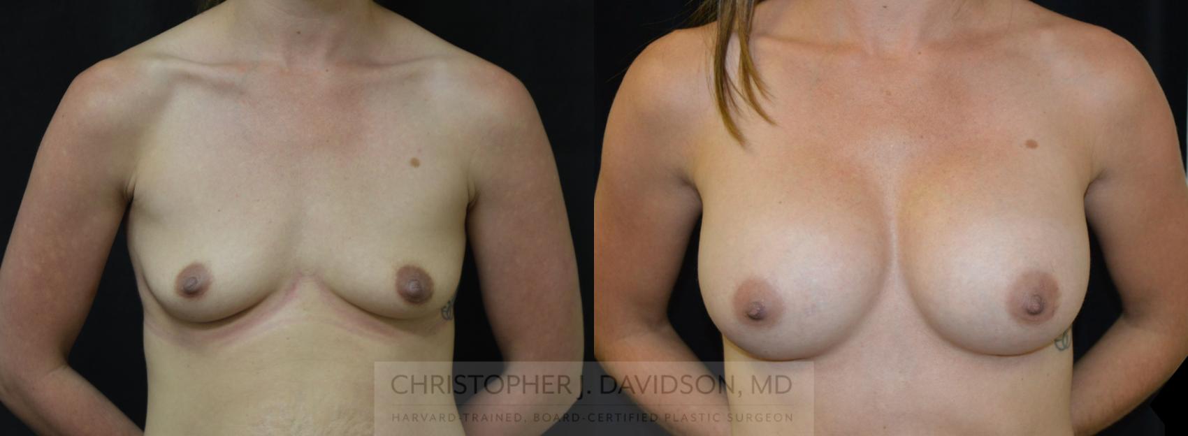 Breast Augmentation Case 454 Before & After Front | Boston, MA | Christopher J. Davidson, MD
