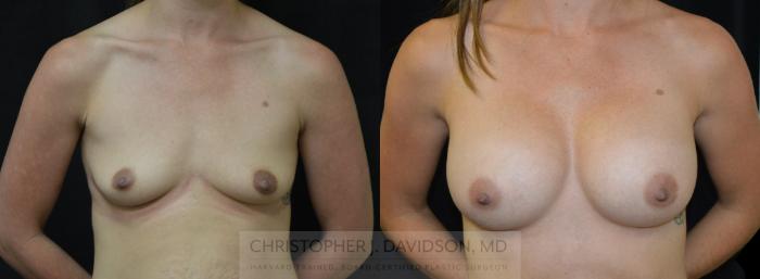 Breast Augmentation Case 454 Before & After Front | Boston, MA | Christopher J. Davidson, MD