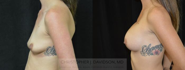 Breast Augmentation Case 454 Before & After Left Side | Boston, MA | Christopher J. Davidson, MD