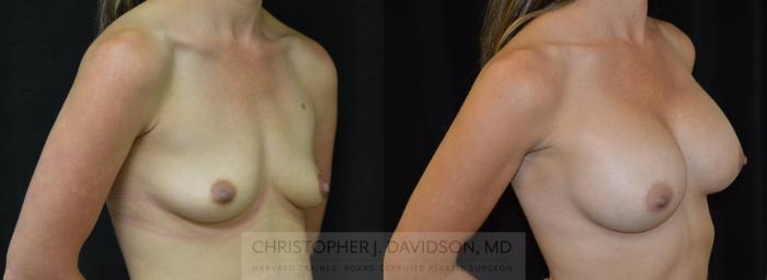 Breast Augmentation Case 454 Before & After Right Oblique | Boston, MA | Christopher J. Davidson, MD