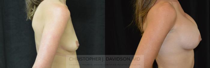 Breast Augmentation Case 454 Before & After Right Side | Boston, MA | Christopher J. Davidson, MD