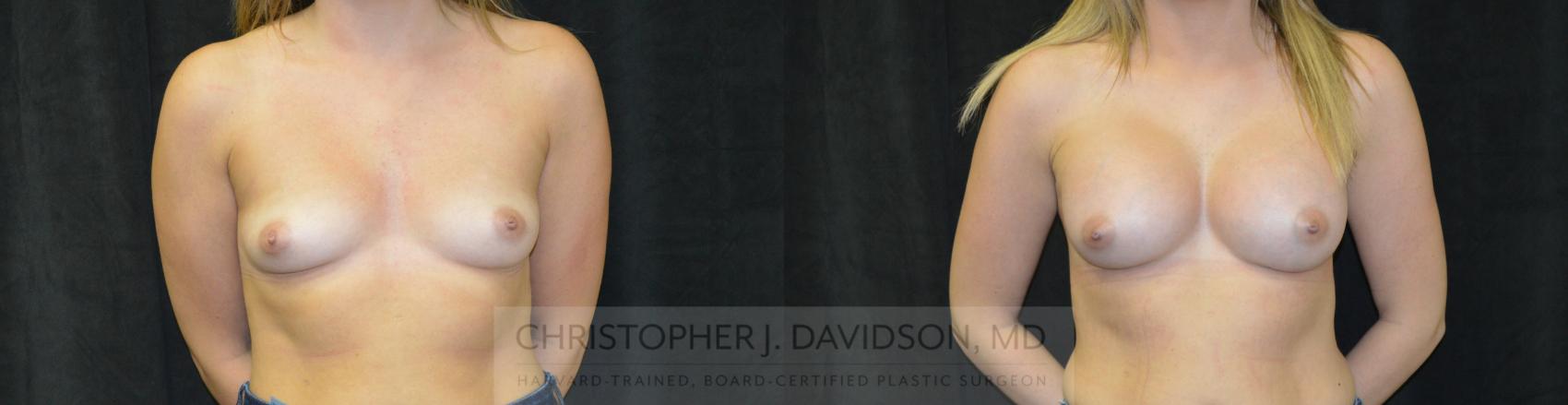 Breast Augmentation Case 456 Before & After Front | Boston, MA | Christopher J. Davidson, MD