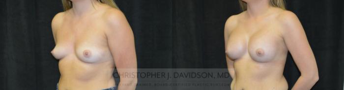 Breast Augmentation Case 456 Before & After Left Oblique | Boston, MA | Christopher J. Davidson, MD