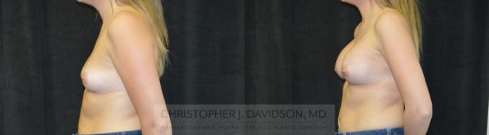 Breast Augmentation Case 456 Before & After Left Side | Boston, MA | Christopher J. Davidson, MD
