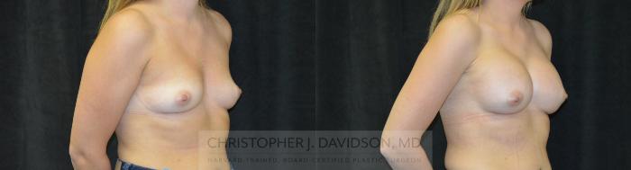 Breast Augmentation Case 456 Before & After Right Oblique | Boston, MA | Christopher J. Davidson, MD