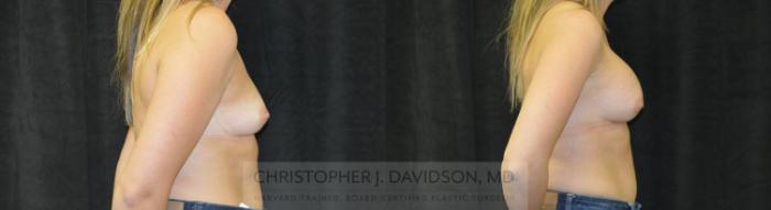 Breast Augmentation Case 456 Before & After Right Side | Boston, MA | Christopher J. Davidson, MD