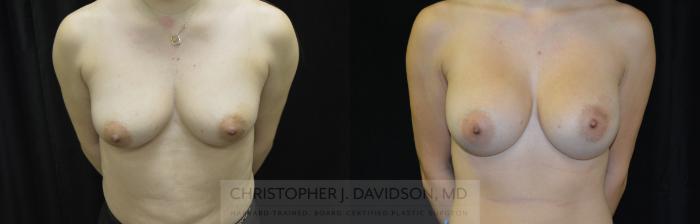 Breast Augmentation Case 461 Before & After Front | Boston, MA | Christopher J. Davidson, MD
