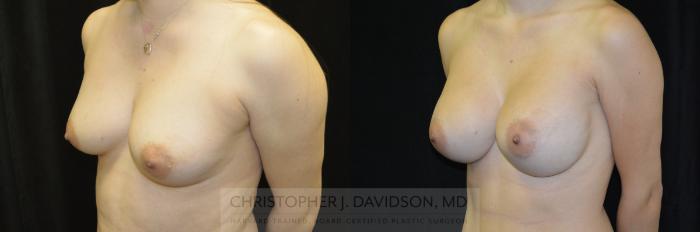 Breast Augmentation Case 461 Before & After Left Oblique | Boston, MA | Christopher J. Davidson, MD