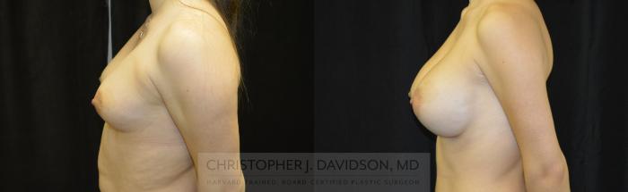 Breast Augmentation Case 461 Before & After Left Side | Boston, MA | Christopher J. Davidson, MD