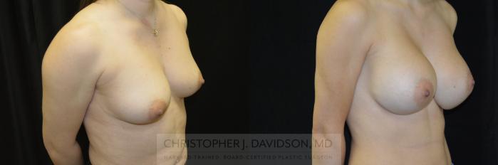 Breast Augmentation Case 461 Before & After Right Oblique | Boston, MA | Christopher J. Davidson, MD
