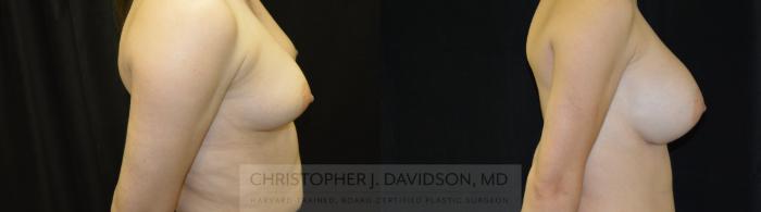 Breast Augmentation Case 461 Before & After Right Side | Boston, MA | Christopher J. Davidson, MD