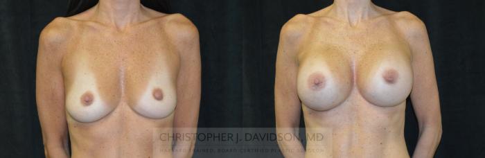 Breast Augmentation Case 462 Before & After Front | Boston, MA | Christopher J. Davidson, MD