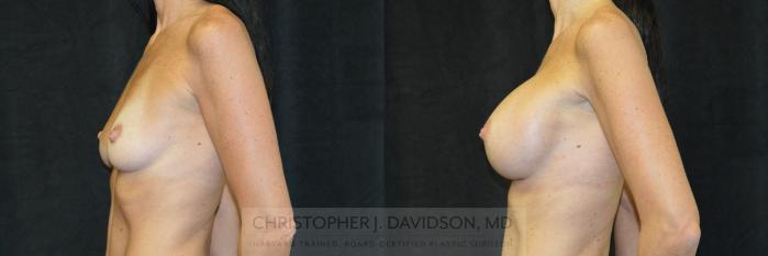 Breast Augmentation Case 462 Before & After Left Side | Boston, MA | Christopher J. Davidson, MD