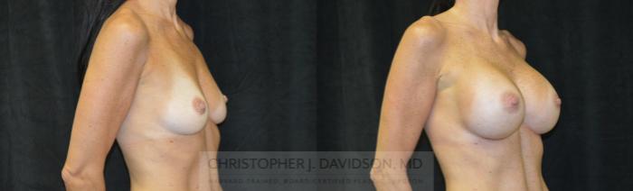 Breast Augmentation Case 462 Before & After Right Oblique | Boston, MA | Christopher J. Davidson, MD