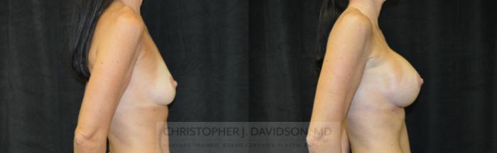 Breast Augmentation Case 462 Before & After Right Side | Boston, MA | Christopher J. Davidson, MD