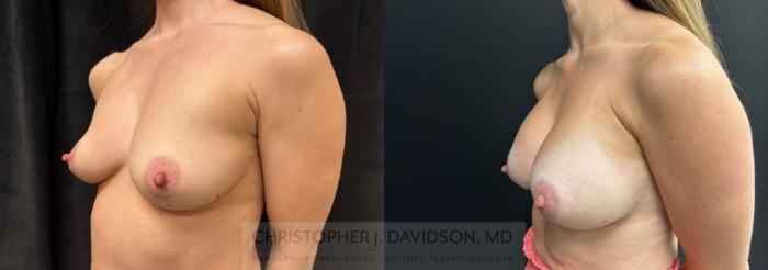 Breast Augmentation Case 467 Before & After Left Oblique | Boston, MA | Christopher J. Davidson, MD