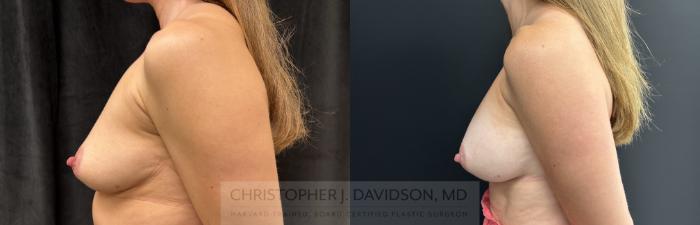 Breast Augmentation Case 467 Before & After Left Side | Boston, MA | Christopher J. Davidson, MD