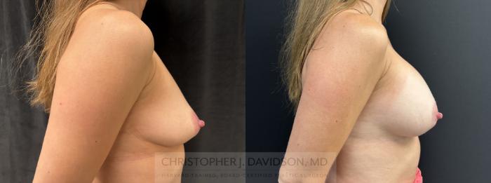 Breast Augmentation Case 467 Before & After Right Side | Boston, MA | Christopher J. Davidson, MD