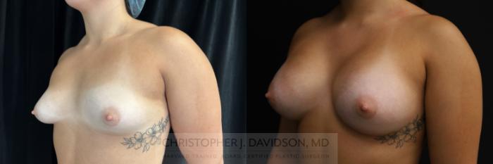 Breast Augmentation Case 469 Before & After Left Oblique | Boston, MA | Christopher J. Davidson, MD