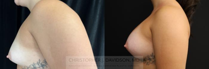 Breast Augmentation Case 469 Before & After Left Side | Boston, MA | Christopher J. Davidson, MD