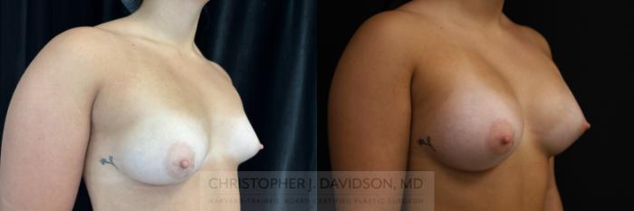 Breast Augmentation Case 469 Before & After Right Oblique | Boston, MA | Christopher J. Davidson, MD