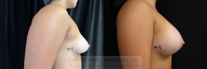 Breast Augmentation Case 469 Before & After Right Side | Boston, MA | Christopher J. Davidson, MD