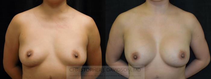 Breast Augmentation Case 47 Before & After View #1 | Boston, MA | Christopher J. Davidson, MD