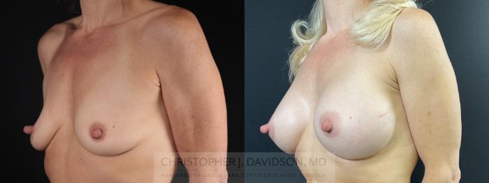 Breast Augmentation Case 472 Before & After Left Oblique | Boston, MA | Christopher J. Davidson, MD