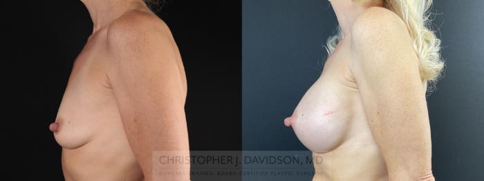 Breast Augmentation Case 472 Before & After Left Side | Boston, MA | Christopher J. Davidson, MD