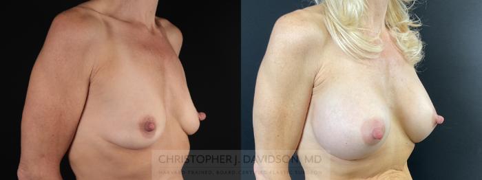 Breast Augmentation Case 472 Before & After Right Oblique | Boston, MA | Christopher J. Davidson, MD