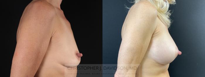 Breast Augmentation Case 472 Before & After Right Side | Boston, MA | Christopher J. Davidson, MD