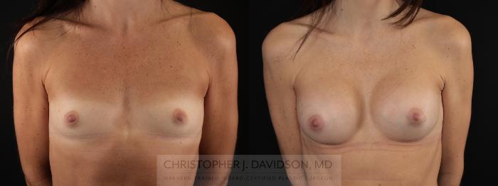 Breast Augmentation Case 478 Before & After Front | Boston, MA | Christopher J. Davidson, MD