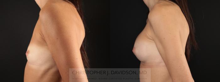 Breast Augmentation Case 478 Before & After Left Side | Boston, MA | Christopher J. Davidson, MD