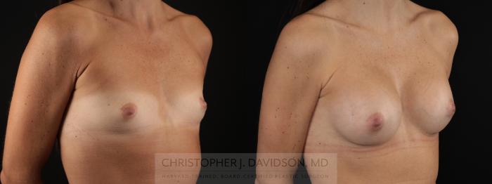 Breast Augmentation Case 478 Before & After Right Oblique | Boston, MA | Christopher J. Davidson, MD