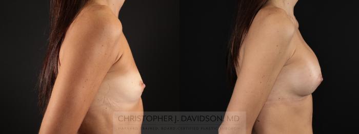 Breast Augmentation Case 478 Before & After Right Side | Boston, MA | Christopher J. Davidson, MD