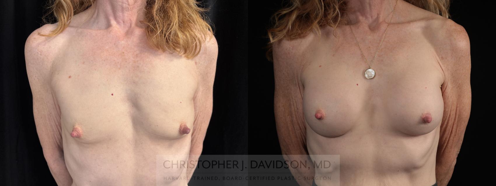 Breast Augmentation Case 480 Before & After Front | Boston, MA | Christopher J. Davidson, MD