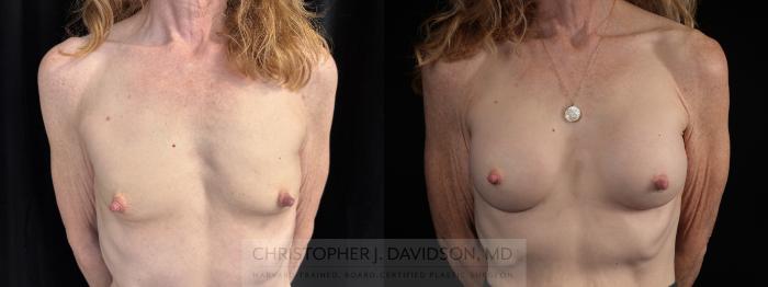 Breast Augmentation Case 480 Before & After Front | Boston, MA | Christopher J. Davidson, MD