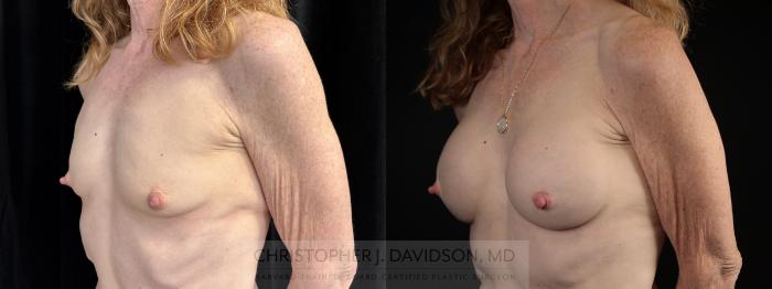 Breast Augmentation Case 480 Before & After Left Oblique | Boston, MA | Christopher J. Davidson, MD