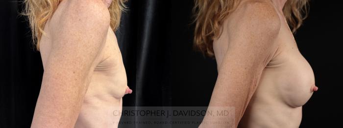 Breast Augmentation Case 480 Before & After Right Side | Boston, MA | Christopher J. Davidson, MD