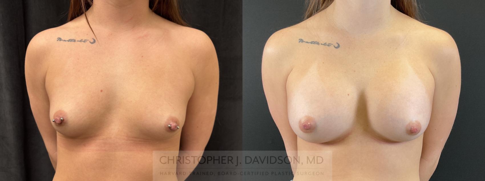 Breast Augmentation