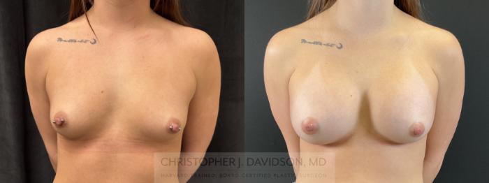 Breast Augmentation